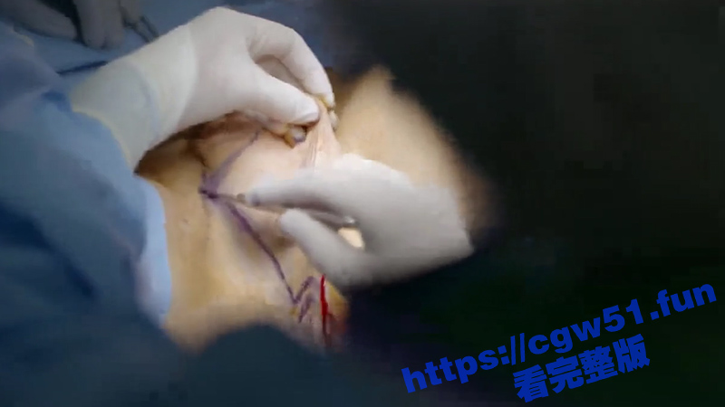 血腥重口 慎入！罕见的医院内部变性手术视频流出 全程皱眉看完 太痛了