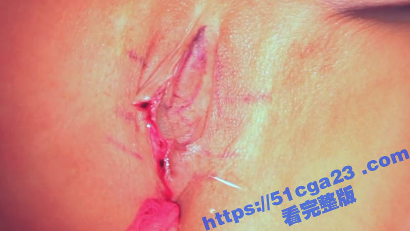 阴唇整形术详细程序 3
