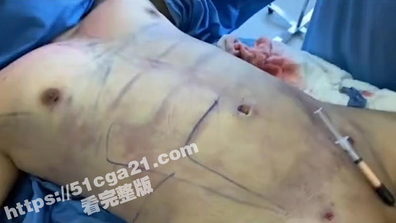 鸡巴增大手术全过程（3）