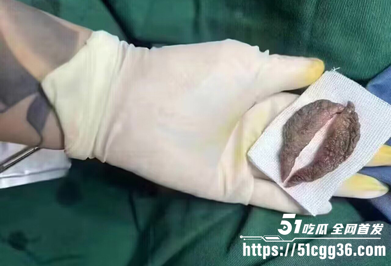 处女膜缩阴手术视频讲解 4 拷贝