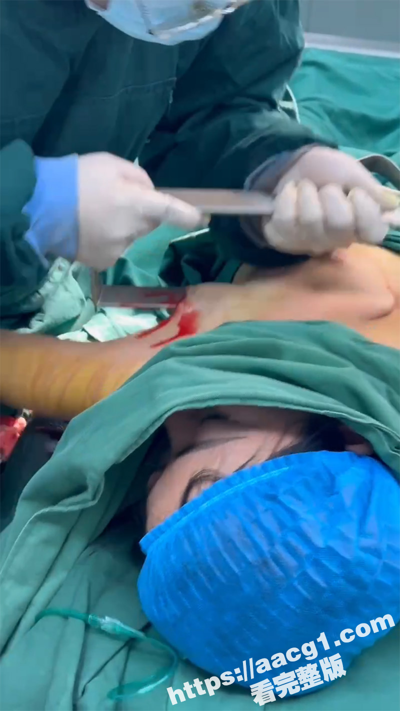 隆胸整形手术现场 平乳妹秒变巨乳御姐 手术过程偷拍流出 女人为变美 对自己太狠了